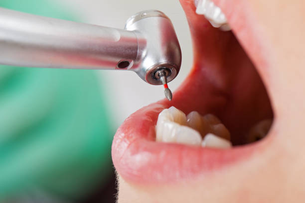 Best Emergency Wisdom Teeth Removal in Shiloh, PA